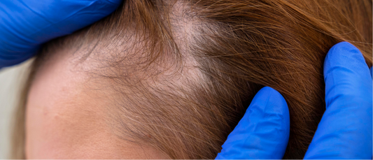 Conoce los diferentes tipos de alopecia