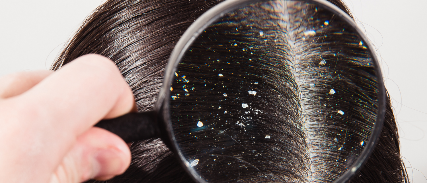 Recomendaciones para combatir la caspa