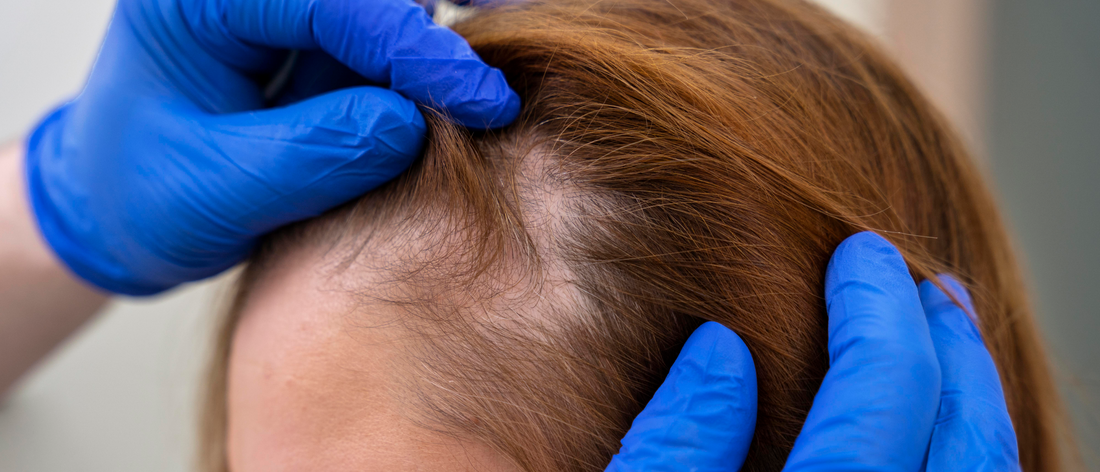 Alopecia androgénica femenina